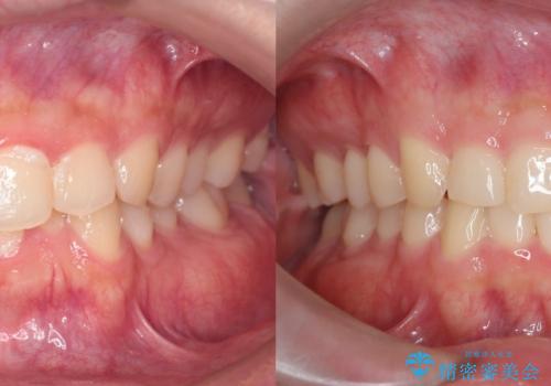 【インビザライン】前歯のガタガタと、前歯の噛み合わせが深いことを治したい。