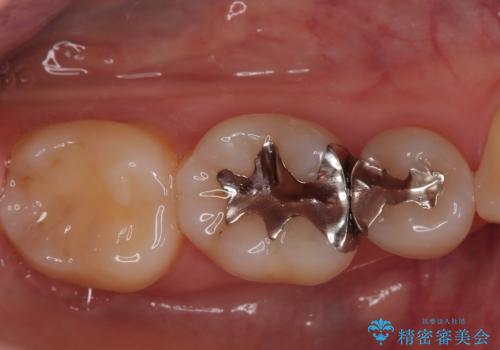 【ハイブリッドインレー】銀歯を白くしたい の治療前