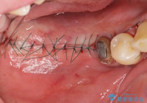 歯周病により抜去した歯のインプラント治療の治療中