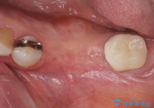 下顎骨隆起を用いた骨造成・インプラント補綴の治療中