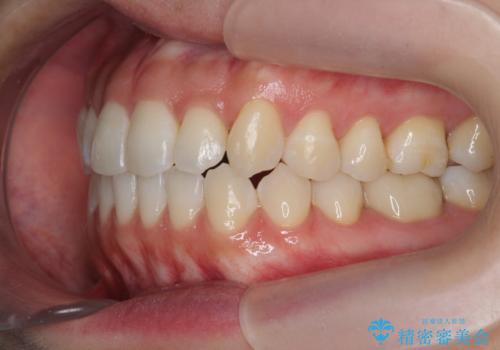 [ インビザライン ]  前歯のガタつきをマウスピース矯正で改善の治療後