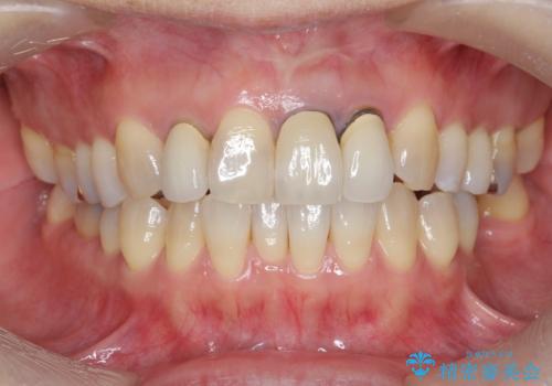 [ セラミック治療 ]  見た目の気になる前歯を綺麗にしたいの治療前