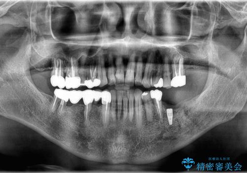 【インプラント】銀歯が取れて歯ごと折れたの治療中