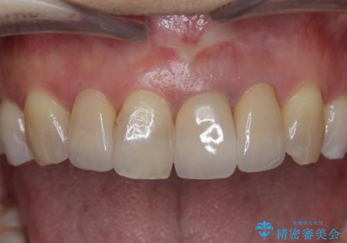 [ セラミック治療 ]  見た目の気になる前歯を綺麗にしたいの治療後