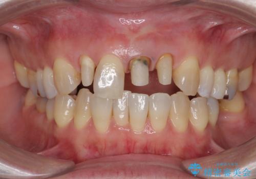 [ セラミック治療 ]  見た目の気になる前歯を綺麗にしたいの治療中