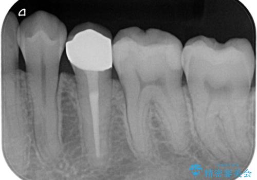 【オールセラミッククラウン】根管治療した歯の被せ物治療の治療後