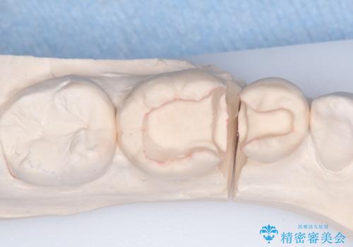 【ハイブリッドインレー】銀歯を白くしたい の治療中