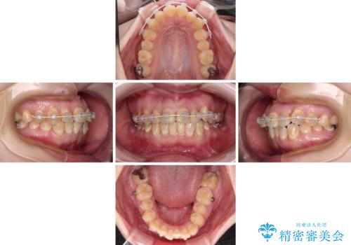 前歯のクロスバイトを改善　ワイヤー矯正を併用したインビザライン矯正の治療中