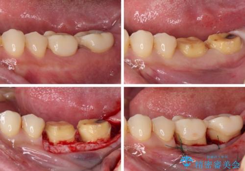 歯肉が腫れて出血する奥歯 歯周外科処置を用いたセラミック補綴治療の治療中