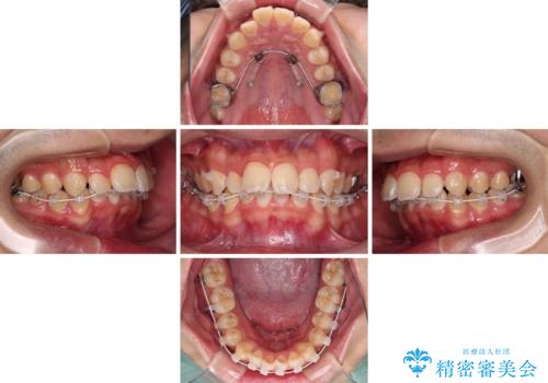 【モニター】飛び出した上の前歯 ワイヤー装置を併用してインビザラインできれいにの治療中
