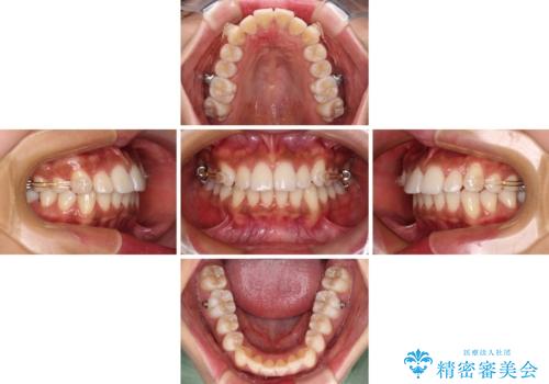 カリエール・ディスタライザーを併用したインビザライン矯正治療の治療中