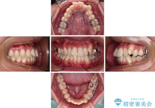 補助装置を併用してスムーズに インビザラインによる矯正治療の治療中
