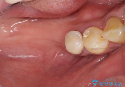 歯周病により抜去した歯のインプラント治療の治療中