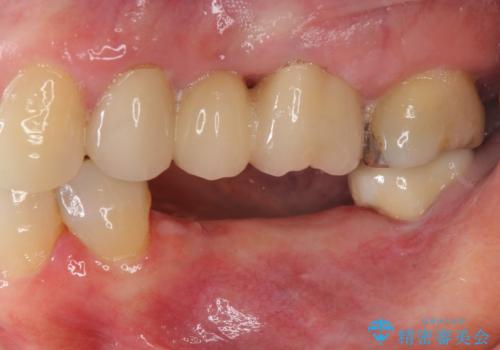 下顎骨隆起を用いた骨造成・インプラント補綴の治療前