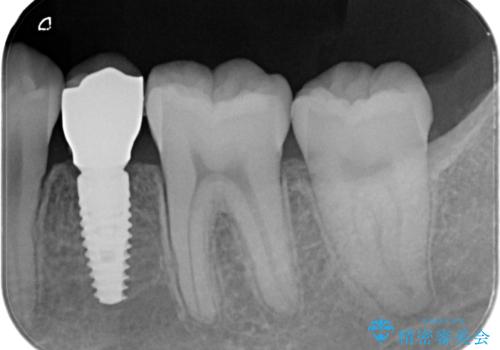 小臼歯のインプラントの治療後