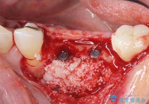 下顎骨隆起を用いた骨造成・インプラント補綴の治療中