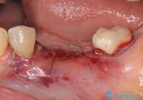 下顎骨隆起を用いた骨造成・インプラント補綴の治療中