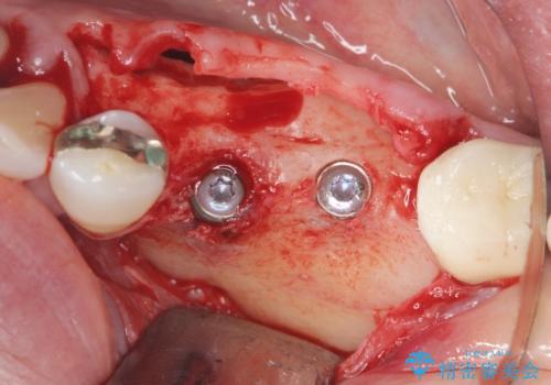 下顎骨隆起を用いた骨造成・インプラント補綴の治療中