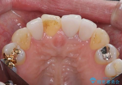 [ セラミック治療 ]  見た目の気になる前歯を綺麗にしたいの治療後