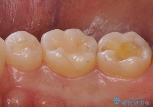 奥歯が欠けた セラミックインレーでの修復後、ナイトガード装着の治療中