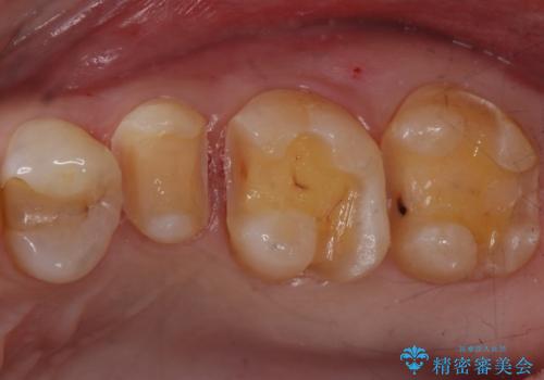 銀歯のやり替え セラミックインレーでの治療の治療中