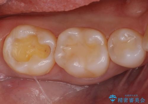 奥歯が欠けた セラミックインレーでの修復後、ナイトガード装着の治療中