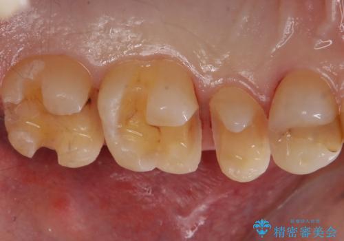 銀歯のやり替え セラミックインレーでの治療の治療中