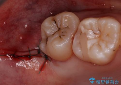 歯の高さを出すための親知らず抜歯と歯肉切除の治療中