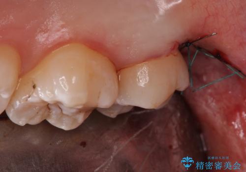 歯の高さを出すための親知らず抜歯と歯肉切除の治療中