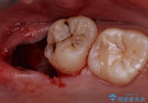 歯の高さを出すための親知らず抜歯と歯肉切除の治療中
