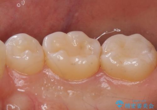 奥歯が欠けた セラミックインレーでの修復後、ナイトガード装着の治療後