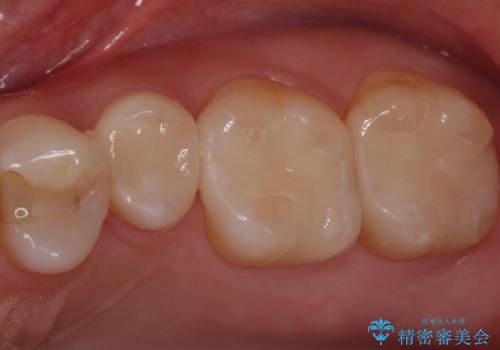 銀歯のやり替え　セラミックインレーでの治療の治療後