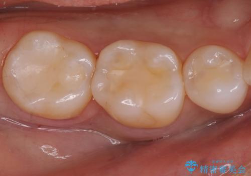 奥歯が欠けた セラミックインレーでの修復後、ナイトガード装着の治療後