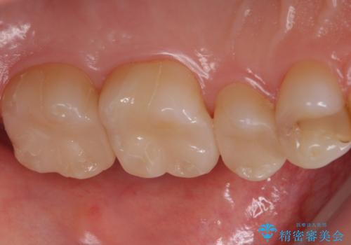 銀歯のやり替え セラミックインレーでの治療の治療後