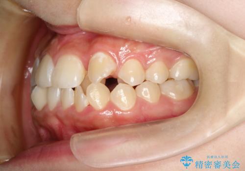 【ハーフリンガル】重度の叢生の治療前