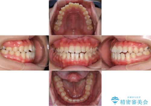 歯茎が薄い方へのインビザライン治療、歯肉退縮予防の治療中
