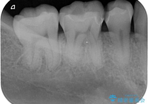 【ハイブリッドインレー】銀歯を白くしたい の治療後