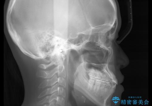 歯茎が薄い方へのインビザライン治療、歯肉退縮予防の治療後