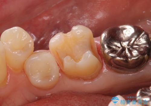 歯がかけた セラミックインレーでの治療の治療中