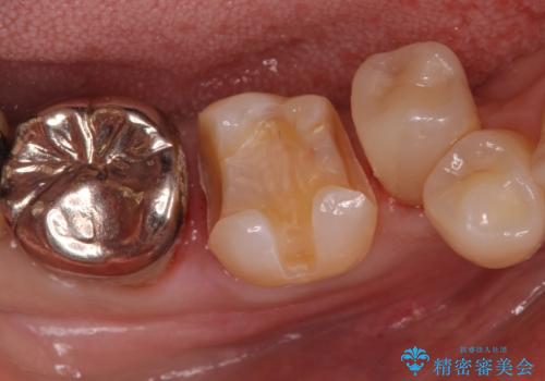 歯がかけた セラミックインレーでの治療の治療中