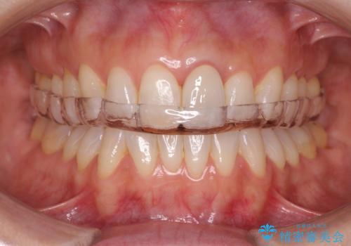 夜中の歯ぎしり ナイトガードで予防の症例 治療後