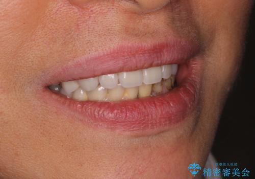 審美性に優れるノンクラスプデンチャー(バネの目立たない入れ歯)