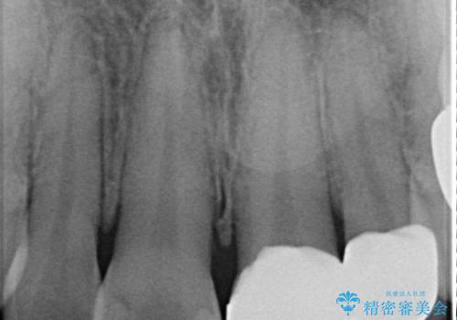 【オールセラミッククラウン】前歯の色が気になる! 左右で歯の長さが違うの治療後