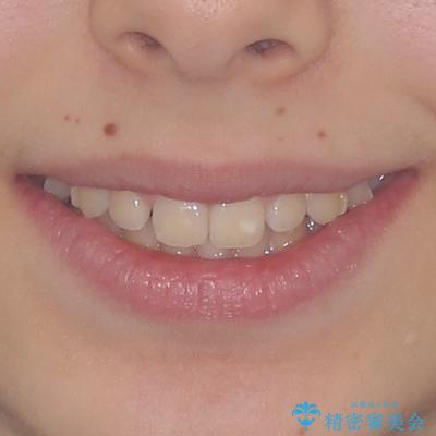 海外で始めたインビザライン 転医手続きにより治療を継続の治療前(顔貌)