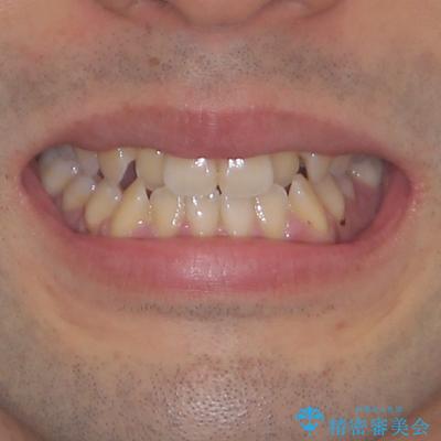 ワイヤー矯正を併用したインビザライン矯正治療の治療前(顔貌)