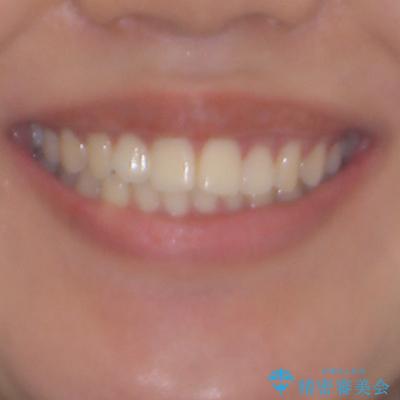 飛び出した上顎前歯 インビザラインで引っ込めるの治療前(顔貌)