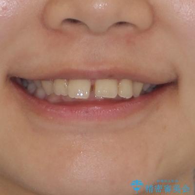 飛び出した前歯をインビザラインですっきりとの治療前(顔貌)