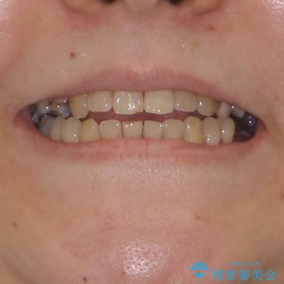 むし歯と咬み合わせで奥歯に負担がかかる　総合歯科治療で悩みを改善の治療前（顔貌）