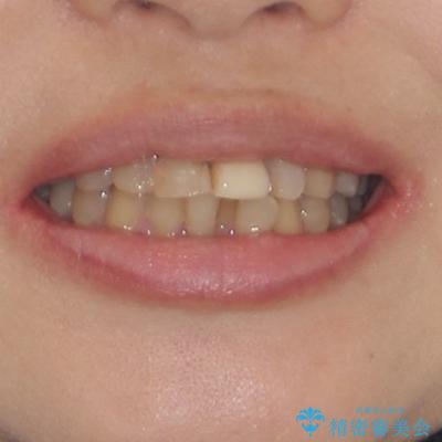 前歯のデコボコをワイヤー矯正できれいに整えるの治療前（顔貌）