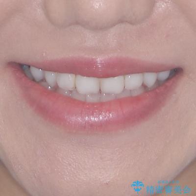 前歯のデコボコをすっきりと インビザライン矯正の治療前(顔貌)